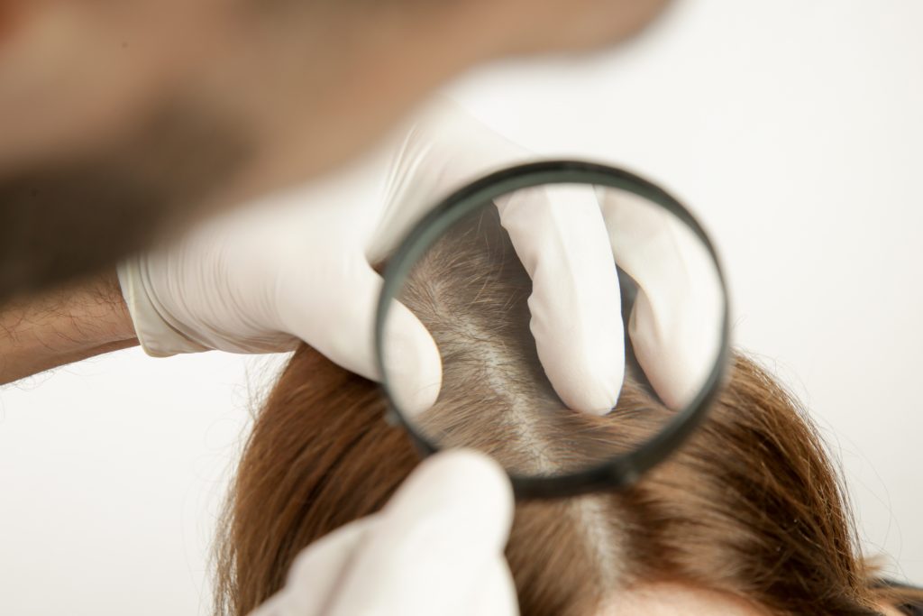 Tratamiento contra la alopecia mujer PRP